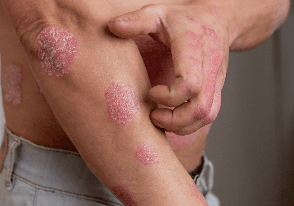 Psoriasis Diagnosis