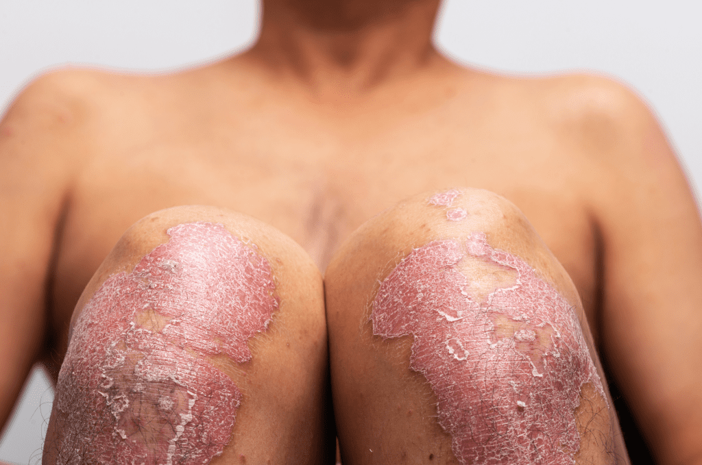 Dermatologists Psoriasis